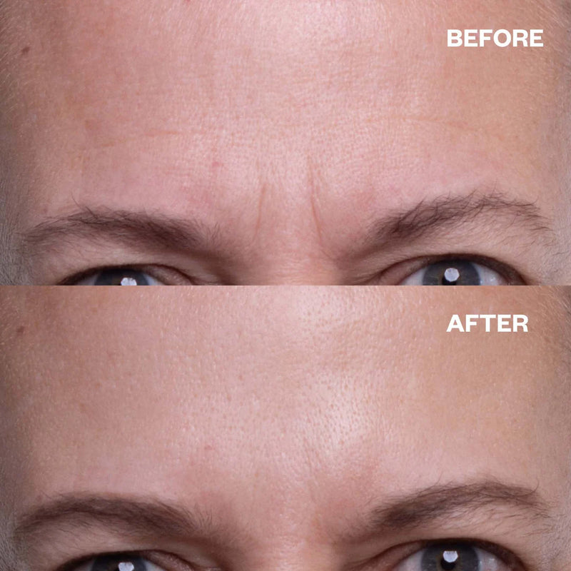 Forehead Wrinkle Patches - 2 Patches